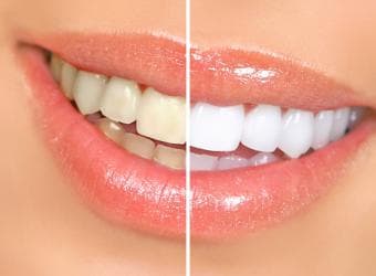 Teeth Whitening vs. Veneers: Which One Is Best?